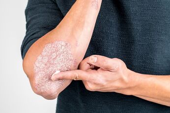 Apply the cream to the skin area damaged by psoriasis