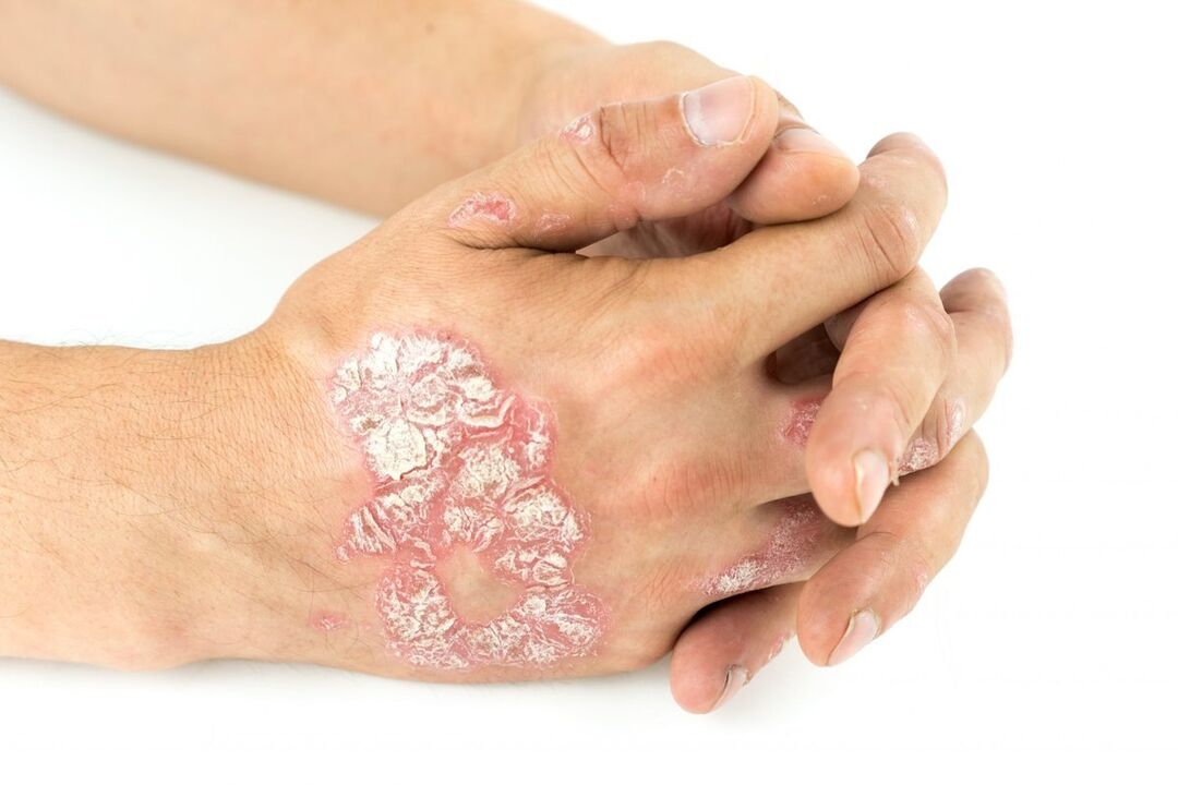 what psoriasis looks like on the hands
