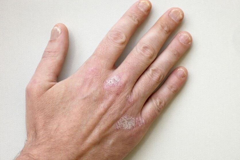 A mandatory symptom of psoriasis is the presence of plaques with scales on the skin. 