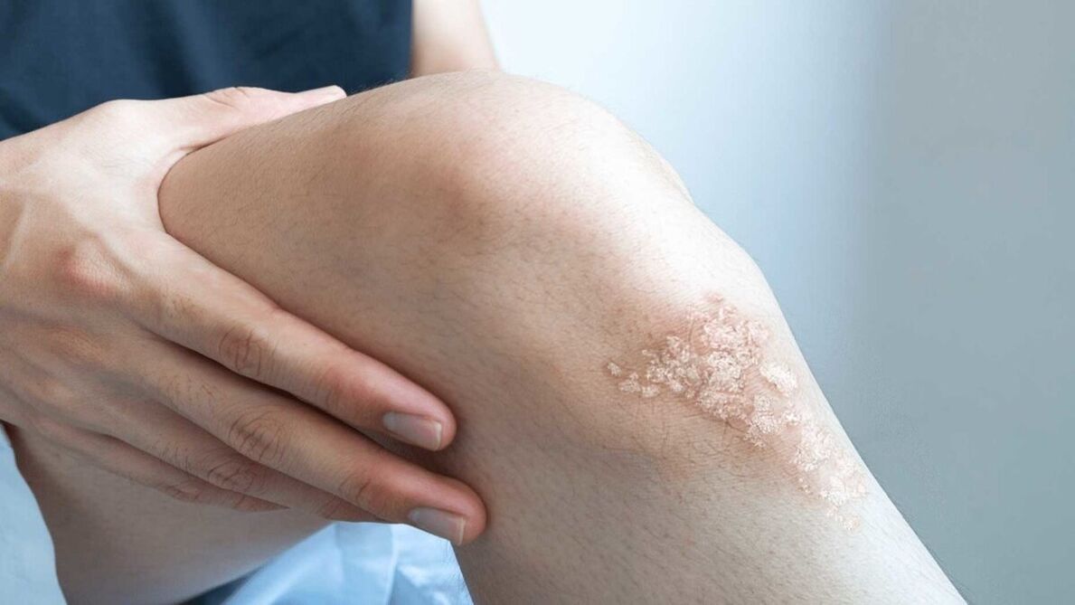 Manifestations of psoriasis on the knees