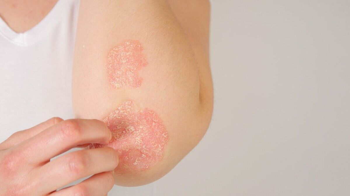 Psoriatic plaques on the elbows