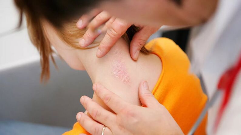 scales and psoriasis plaques on the back of the neck