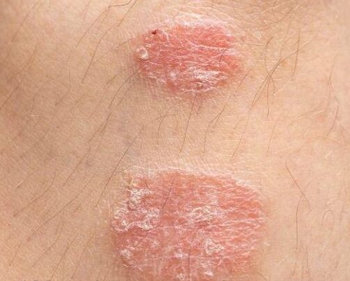 Appearance of psoriatic plates