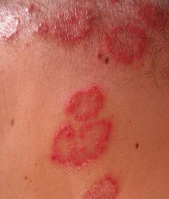 Psoriasis spots