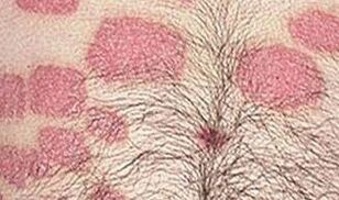 Several pink formations on the abdomen