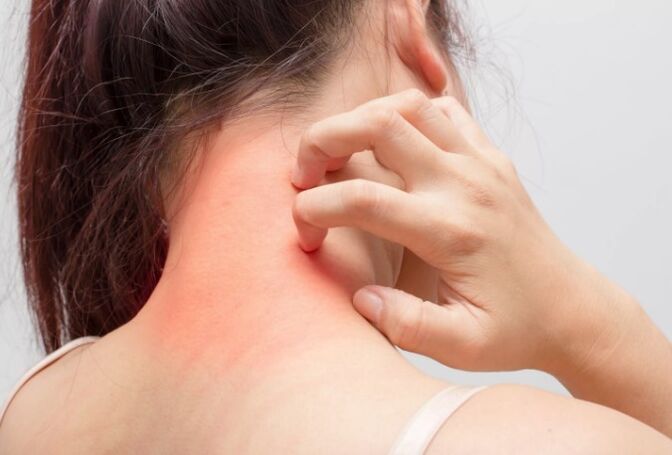 Itching is one of the causes of psoriasis