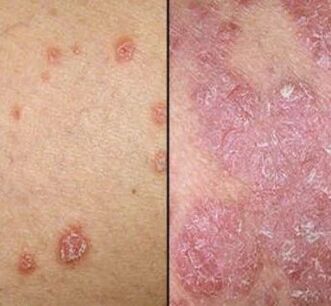 PSORIATIC PLACES