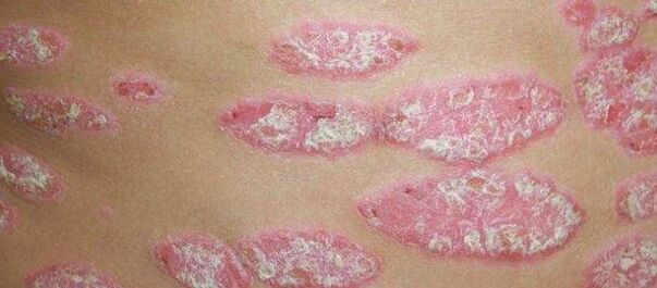 The progressive stage of psoriasis
