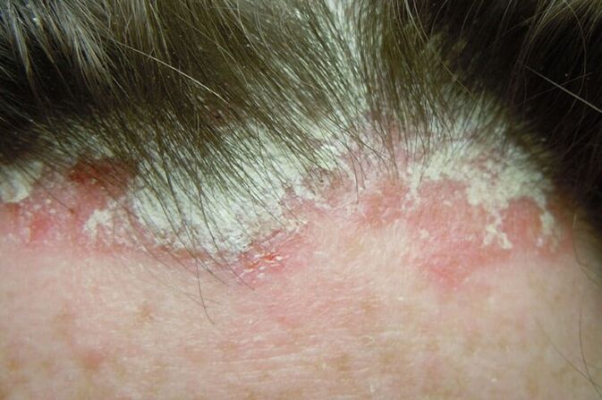 Psoriasis captures the whole hairy part of the head