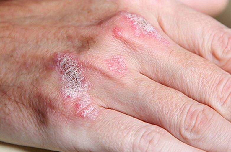 Psoriasis supported by women