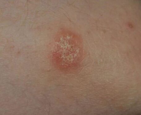 Spot psoriasis