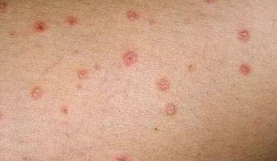 The initial step of psoriasis