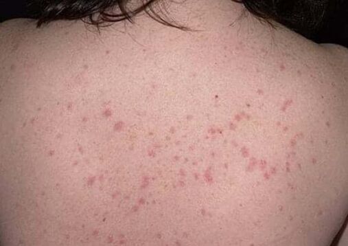 The initial step of psoriasis