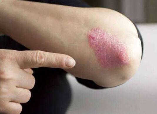 The stationary stadium of psoriasis