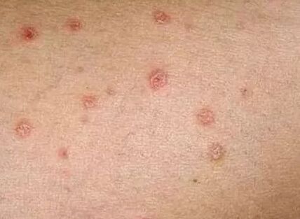 Psoriasis of the initial step