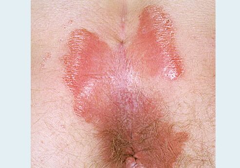Nearby psoriasis