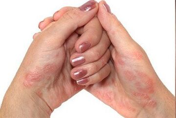 Hands psoriasis