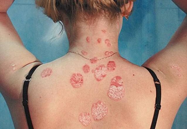 Psoriasis at the rear