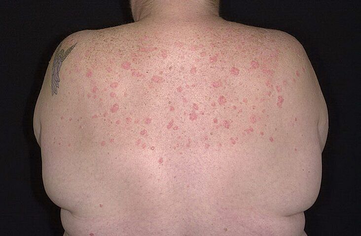Psoriasis on the shoulders