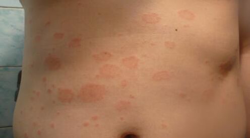 Psoriasis of the initial step
