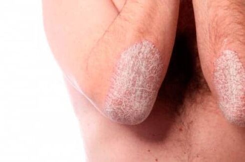 Psoriasis on the elbows