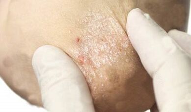 treatment of psoriasis at the attenuation stage