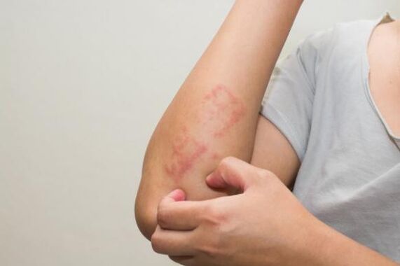 The latest methods of treatment of psoriasis