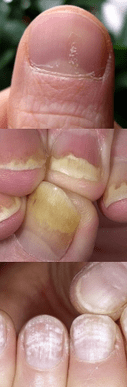 Cloud psoriasis - Initial step