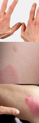 Psoriasis of the initial step on the hands