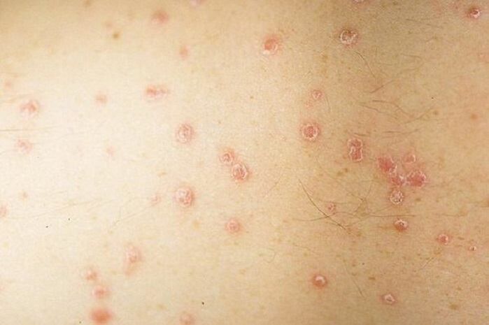 symptoms of localized psoriasis