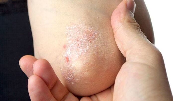 symptoms of psoriasis in the initial stage