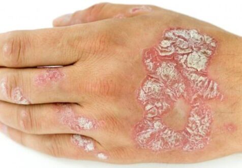 psoriasis at your fingertips