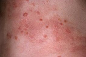 photo of psoriasis on the skin