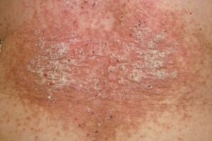 relational stage of psoriasis